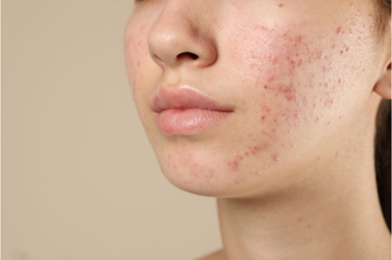How to Get Rid of Acne Scars Naturally (Without Wrecking Your Skin)